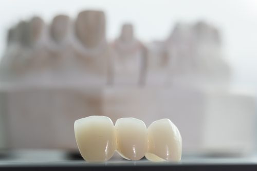 Dental bridges - 3Dental Dublin & Limerick